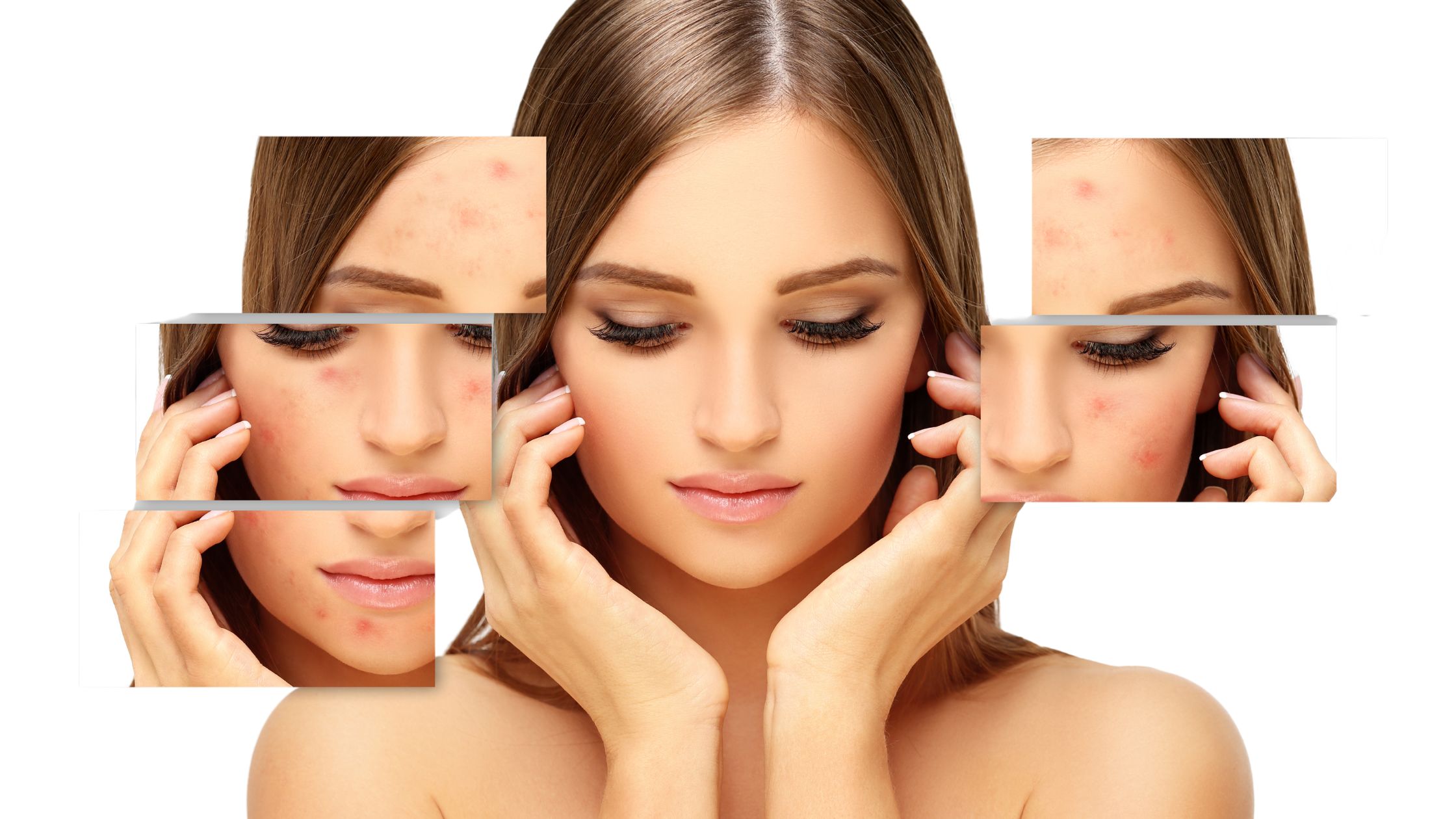 Una ragazza che cerca di capire come curare l'acne.