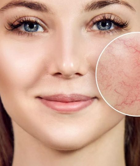 Una ragazza che ha delle vene rosse in viso.